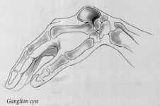 http://karlankas.top/wp-images/ganglion.jpg